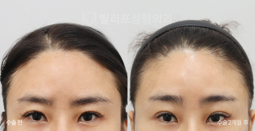Endoscopic Forehead Lift (Bone Tunneling) before and after — Vlif Plastic surgery