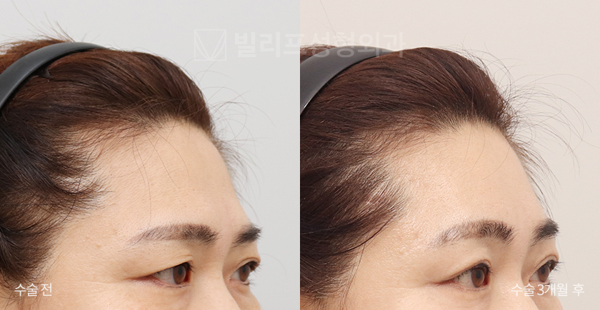 Endoscopic Forehead Lift (Bone Tunneling) before and after — Vlif Plastic surgery