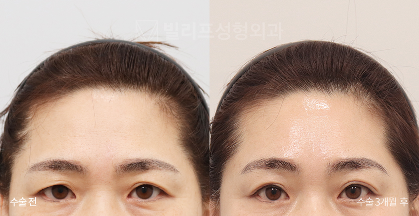Endoscopic Forehead Lift (Bone Tunneling) before and after — Vlif Plastic surgery