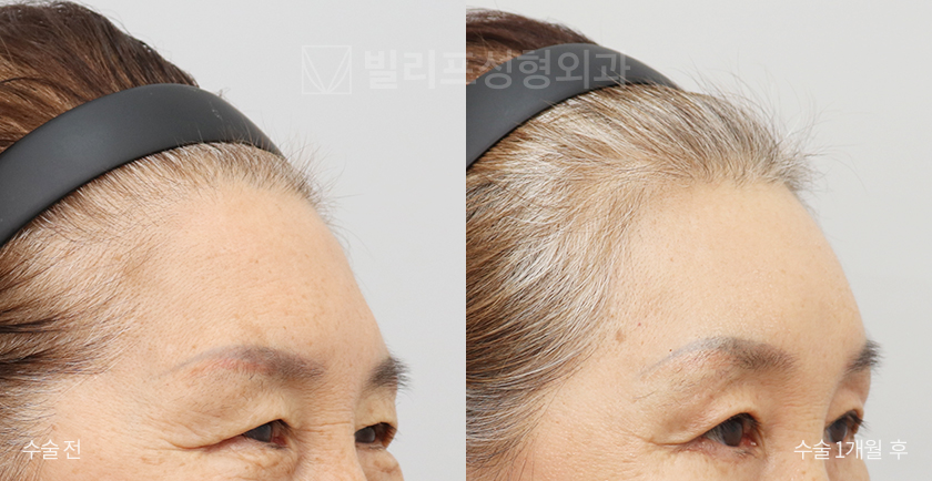 Endoscopic Forehead Lift (Endotine) before and after — Vlif Plastic surgery