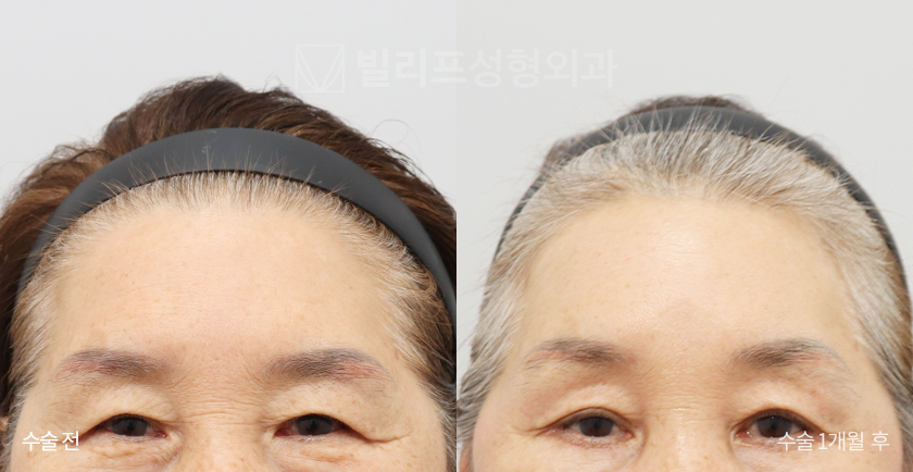 Endoscopic Forehead Lift (Endotine) before and after — Vlif Plastic surgery