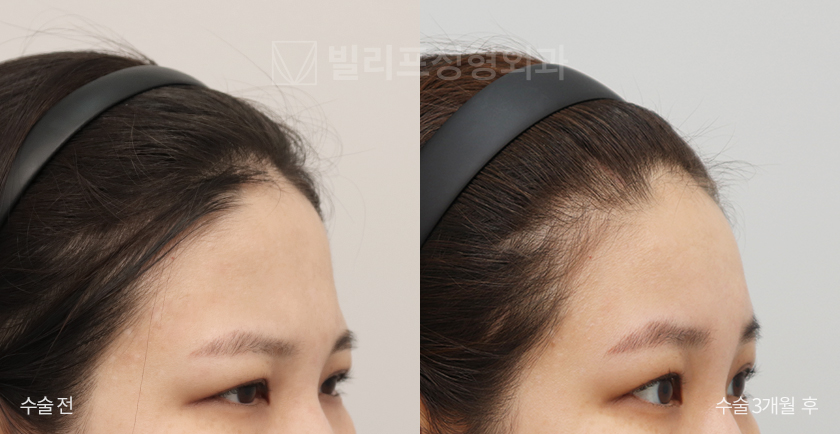 Endoscopic Forehead Lift (Bone Tunneling) before and after — Vlif Plastic surgery