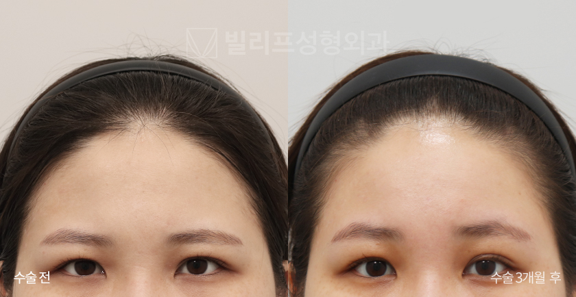 Endoscopic Forehead Lift (Bone Tunneling) before and after — Vlif Plastic surgery