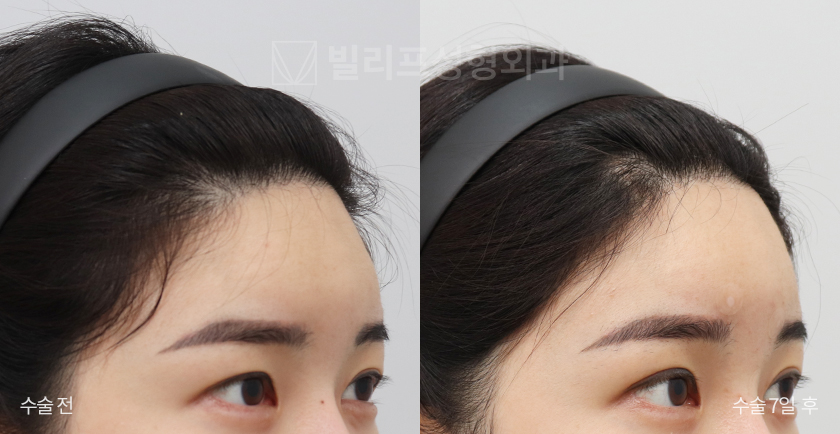 Endoscopic Forehead Lift (Bone Tunneling) before and after — Vlif Plastic surgery