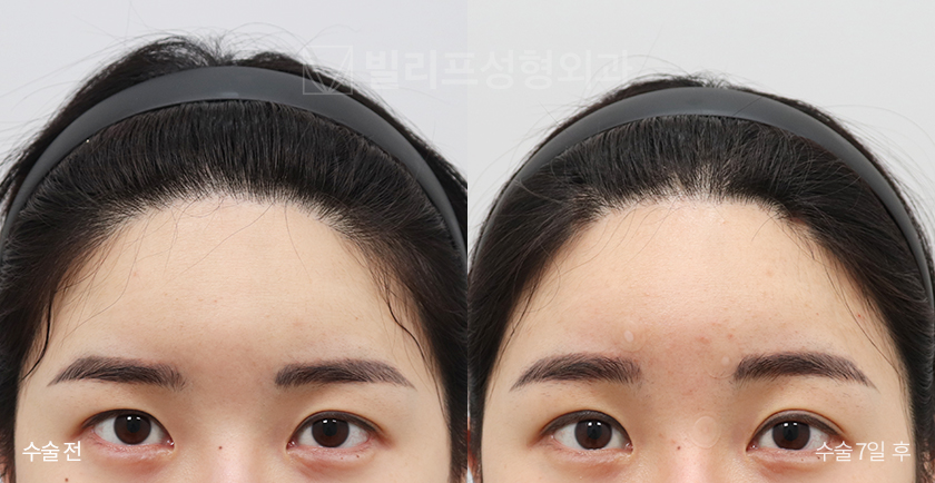 Endoscopic Forehead Lift (Bone Tunneling) before and after — Vlif Plastic surgery