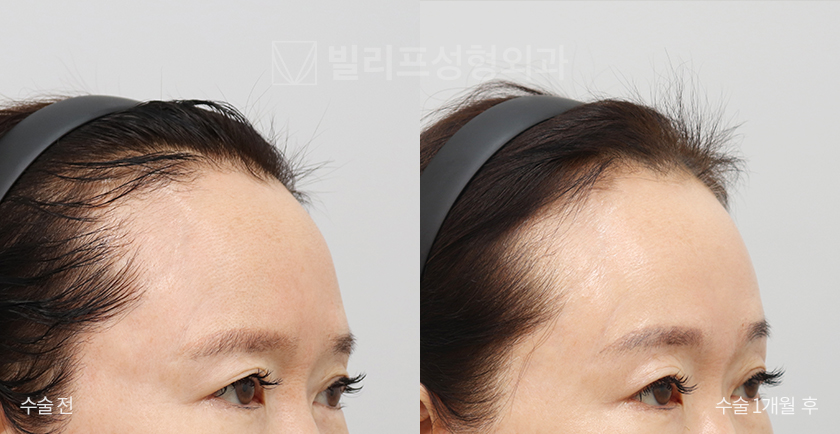 Endoscopic Forehead Lift (Endotine) before and after — Vlif Plastic surgery