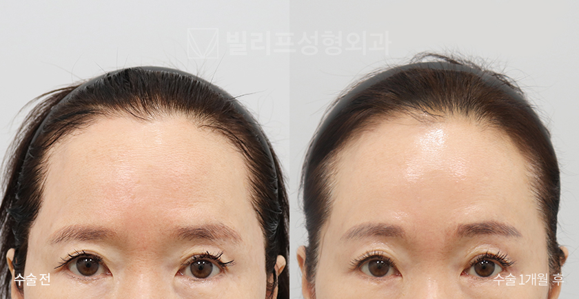 Endoscopic Forehead Lift (Endotine) before and after — Vlif Plastic surgery