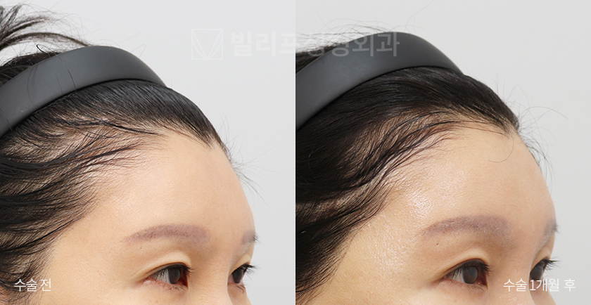 Endoscopic Forehead Lift (Bone Tunneling) before and after — Vlif Plastic surgery
