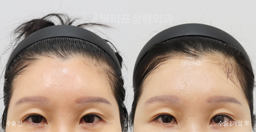 Endoscopic Forehead Lift (Bone Tunneling) before and after — Vlif Plastic surgery