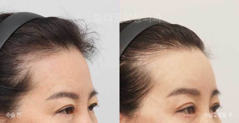 Endoscopic Forehead Lift (Endotine) before and after — Vlif Plastic surgery