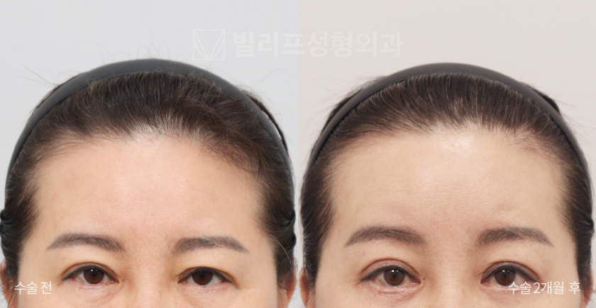 Endoscopic Forehead Lift (Endotine) before and after — Vlif Plastic surgery