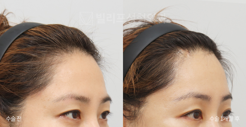 Endoscopic Forehead Lift (Bone Tunneling) before and after — Vlif Plastic surgery