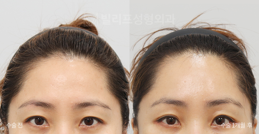 Endoscopic Forehead Lift (Bone Tunneling) before and after — Vlif Plastic surgery