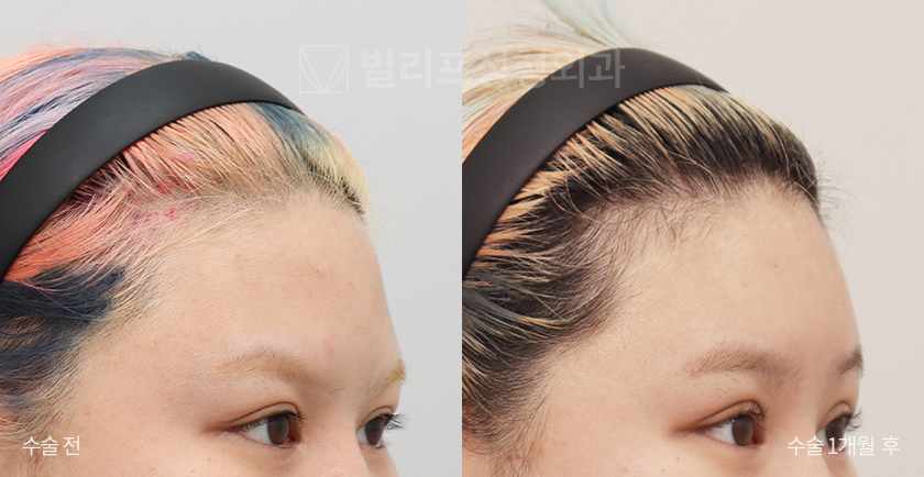 Endoscopic Forehead Lift (Bone Tunneling) before and after — Vlif Plastic surgery
