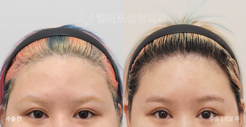 Endoscopic Forehead Lift (Bone Tunneling) before and after — Vlif Plastic surgery