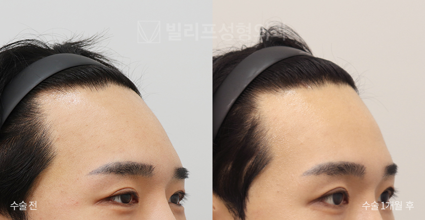 Endoscopic Forehead Lift (Bone Tunneling) before and after — Vlif Plastic surgery
