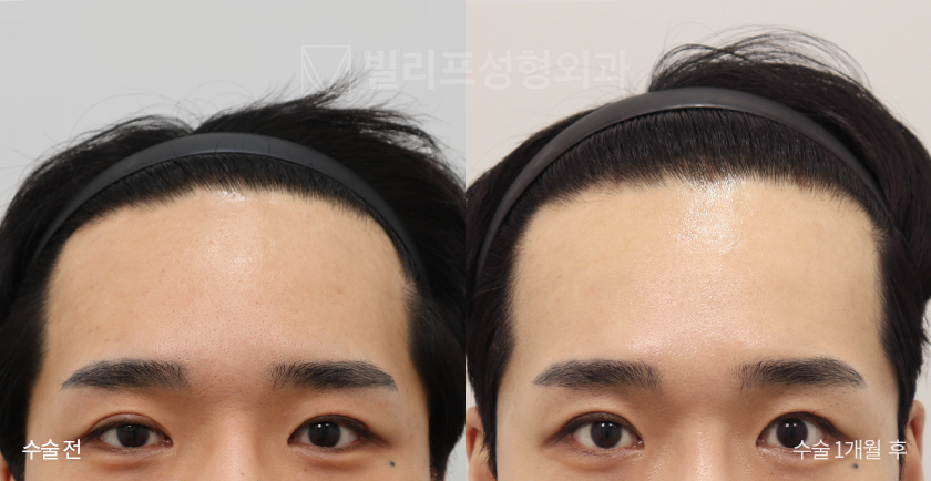 Endoscopic Forehead Lift (Bone Tunneling) before and after — Vlif Plastic surgery