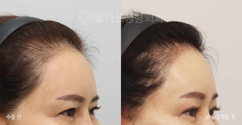 Endoscopic Forehead Lift (Bone Tunneling) before and after — Vlif Plastic surgery