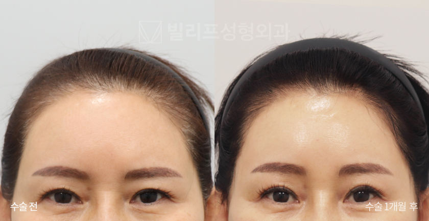 Endoscopic Forehead Lift (Bone Tunneling) before and after — Vlif Plastic surgery