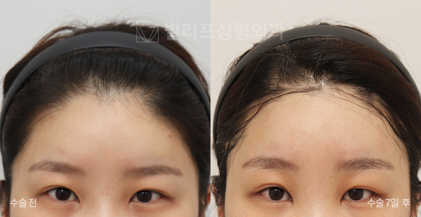 Endoscopic Forehead Lift (Bone Tunneling) before and after — Vlif Plastic surgery