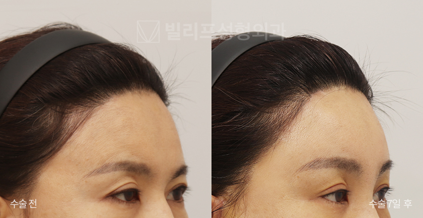 Endoscopic Forehead Lift (Bone Tunneling) before and after — Vlif Plastic surgery
