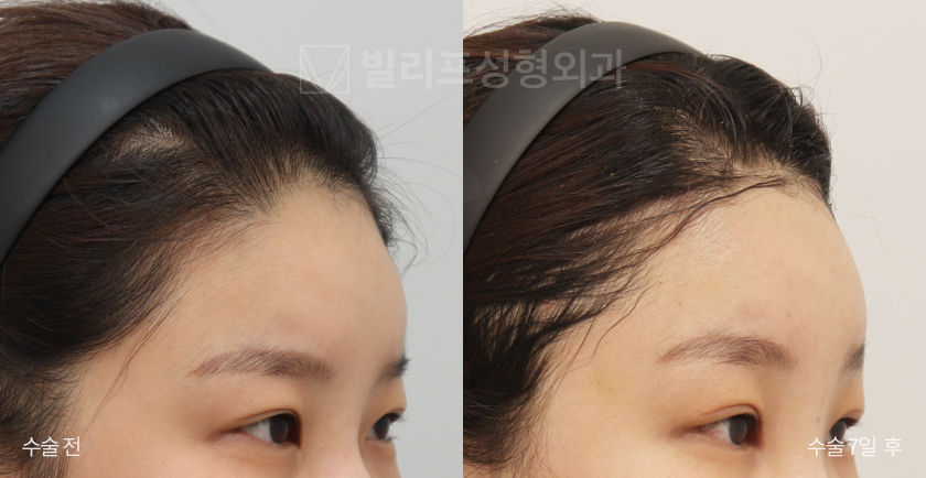 Endoscopic Forehead Lift (Bone Tunneling) before and after — Vlif Plastic surgery