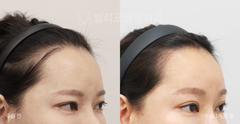 Endoscopic Forehead Lift (Bone Tunneling) before and after — Vlif Plastic surgery