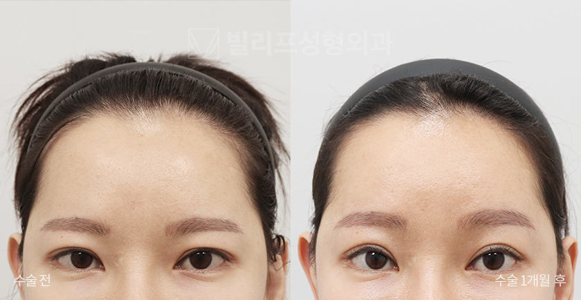 Endoscopic Forehead Lift (Bone Tunneling) before and after — Vlif Plastic surgery