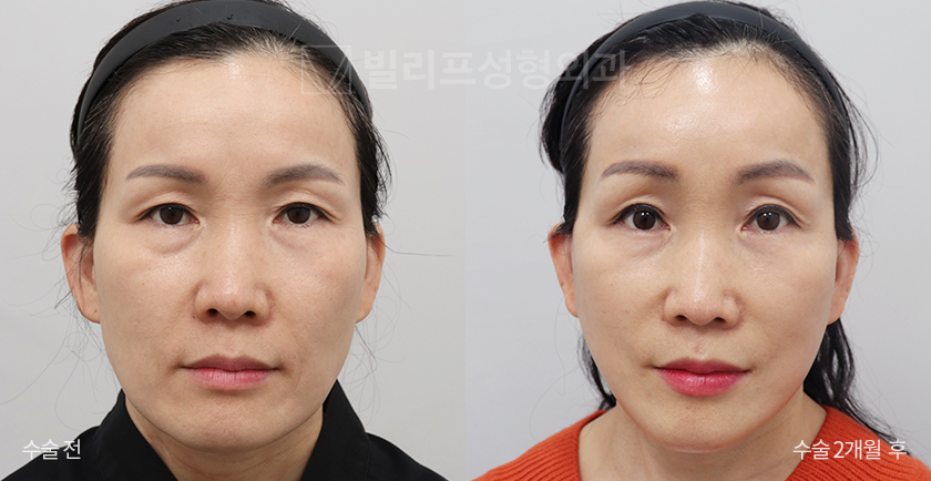 Facelift Endoscopic Forehead Lift before and after — Vlif Plastic surgery