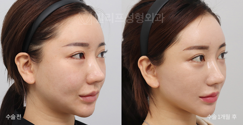 Mini Lift (Lower Face) + Endoscopic Forehead Lift before and after — Vlif Plastic surgery