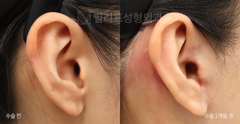 Mini Lift 1-Month Post-op Scar (Ear Line) before and after — Vlif Plastic surgery