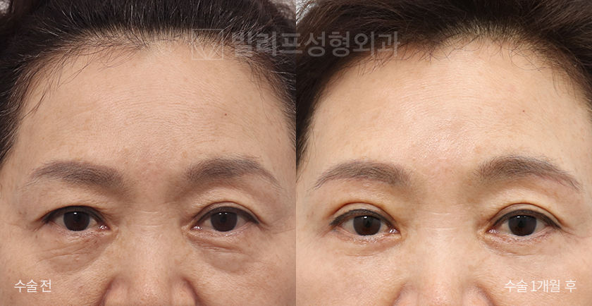 Sub-brow Lift + Lower Blepharoplasty (Fat Removal) before and after — Vlif Plastic surgery
