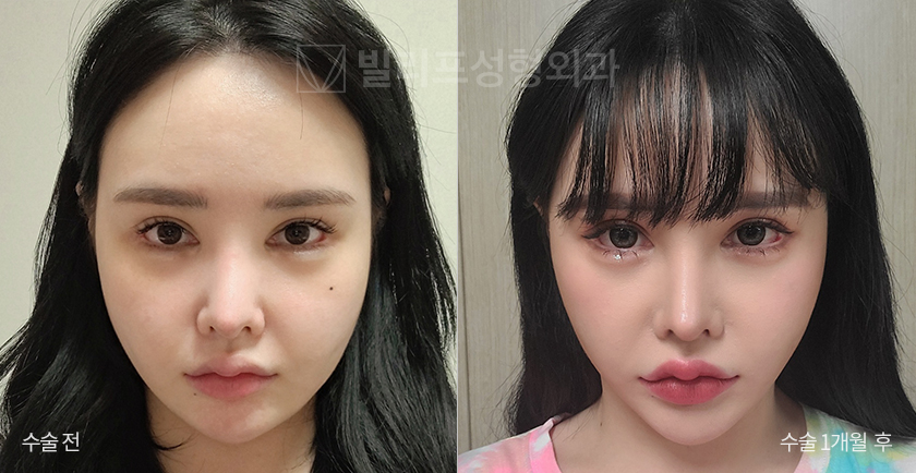 Mini Lift (Selfie) before and after — Vlif Plastic surgery