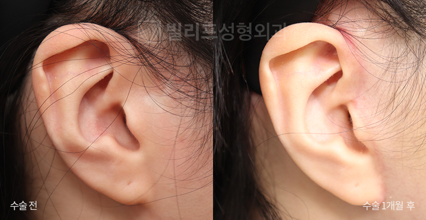 Mini Lift 1-Month Post-op Scar (Mid + Lower Face) before and after — Vlif Plastic surgery