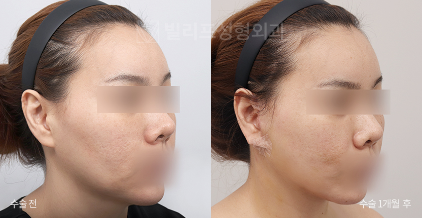Mini Lift (Lower Face) + Facial Liposuction before and after — Vlif Plastic surgery