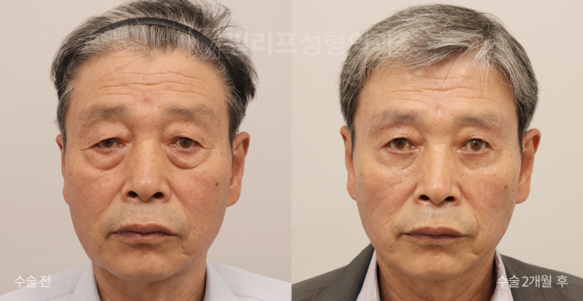 Sub-brow Lift + Lower Blepharoplasty (Fat Removal) before and after — Vlif Plastic surgery