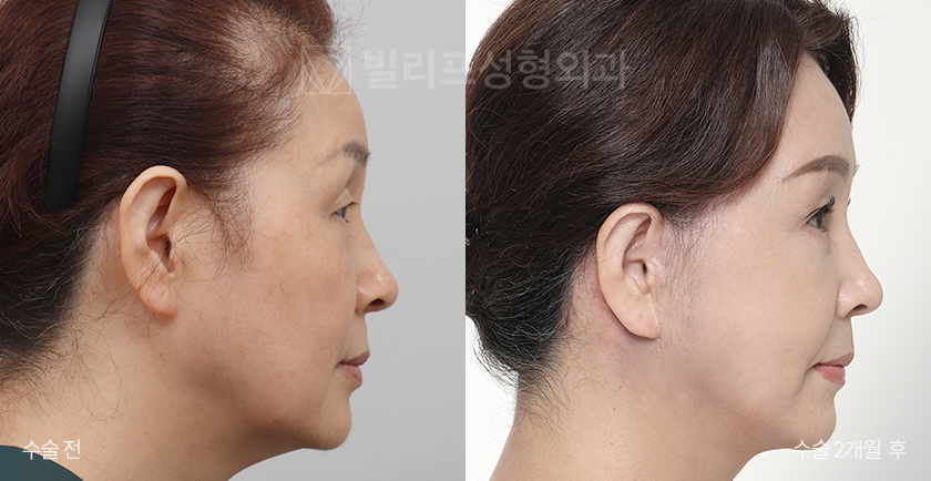 Facelift + Neck Lift + Endoscopic Forehead Lift + Sub-brow Lift + Facial Fat Removal before and after — Vlif Plastic surgery