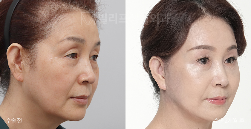 Facelift + Neck Lift + Endoscopic Forehead Lift + Sub-brow Lift + Facial Fat Removal before and after — Vlif Plastic surgery
