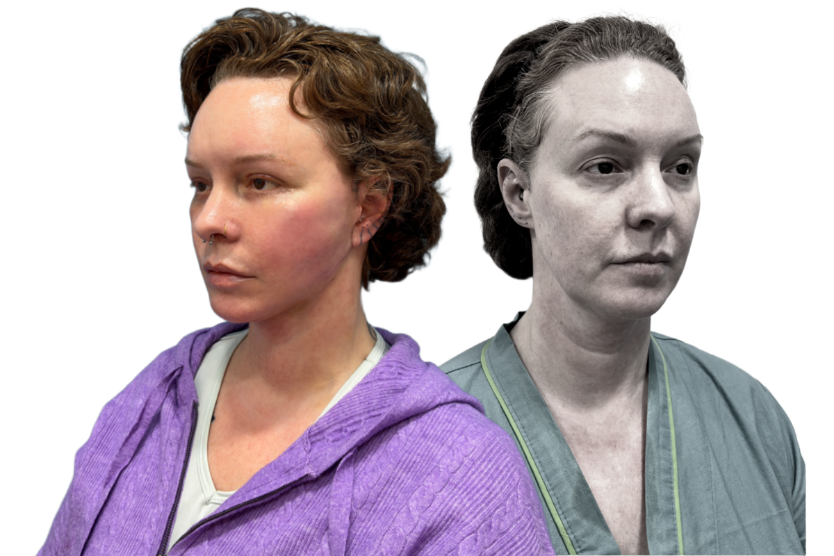 Deep Plane Facelift — NANA Anti-Aging Promotion