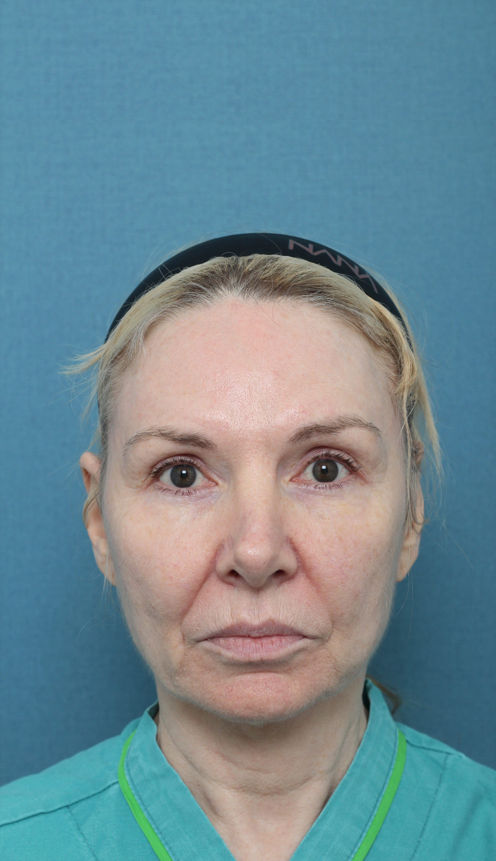Deep Plane Facelift (SMAS layer lifting + retaining ligament release) — before