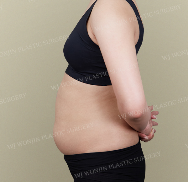 Custom Liposuction — before