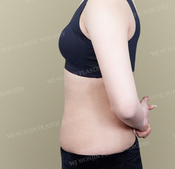 Custom Liposuction — after