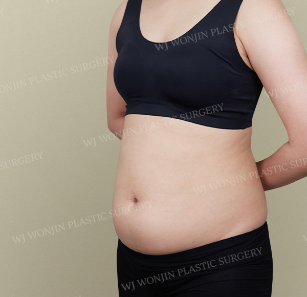 Custom Liposuction — before