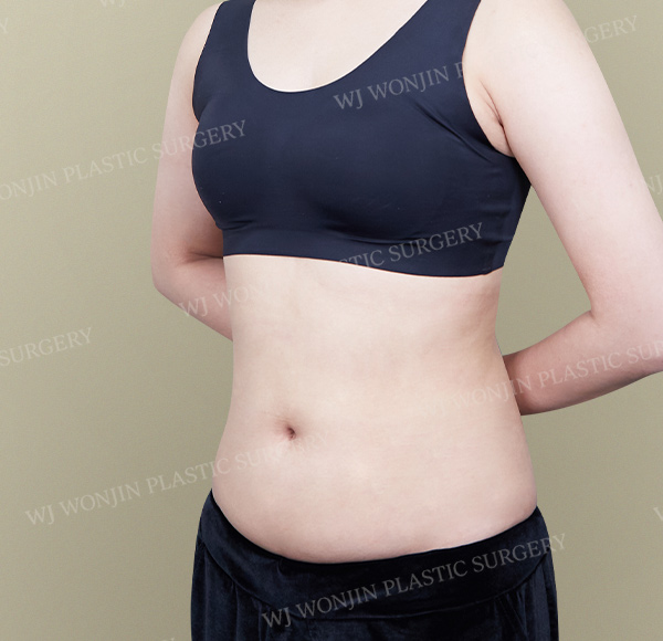 Custom Liposuction — after