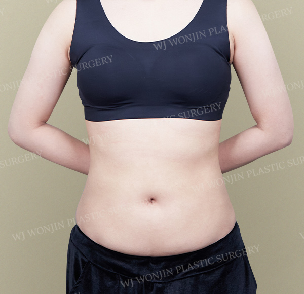 Custom Liposuction — after