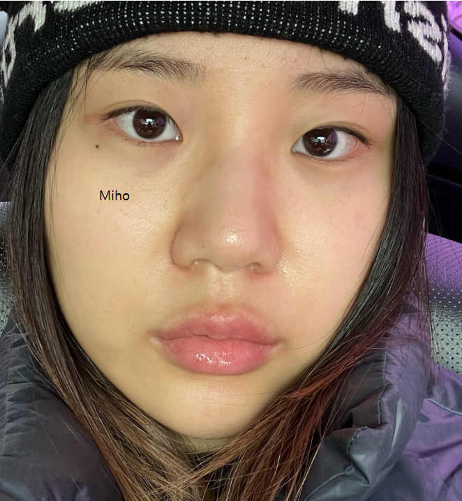 Miho K-Eyes & Rhinoplasty — before