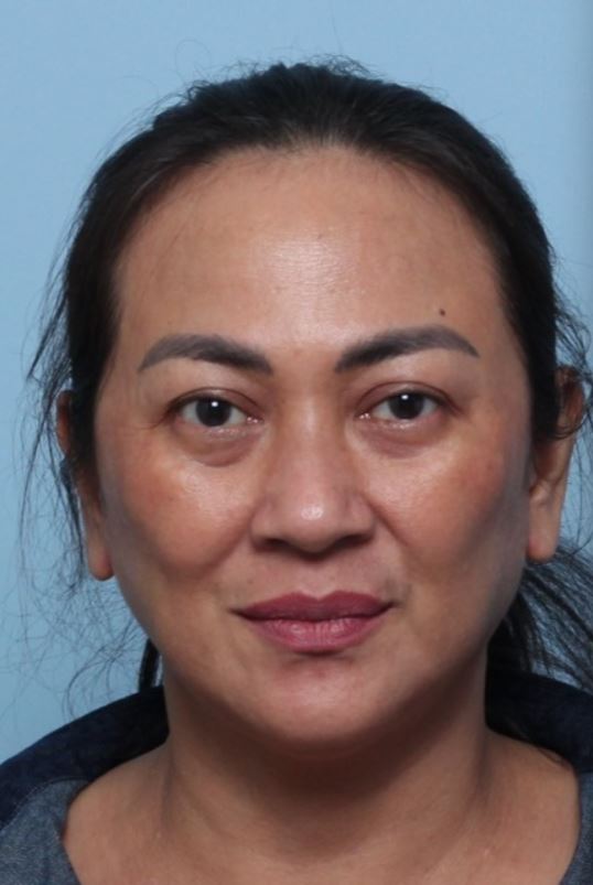 Deep Plane Facelift (SMAS layer lifting + retaining ligament release) — before