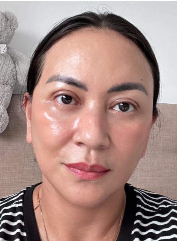 Deep Plane Facelift (SMAS layer lifting + retaining ligament release) — after