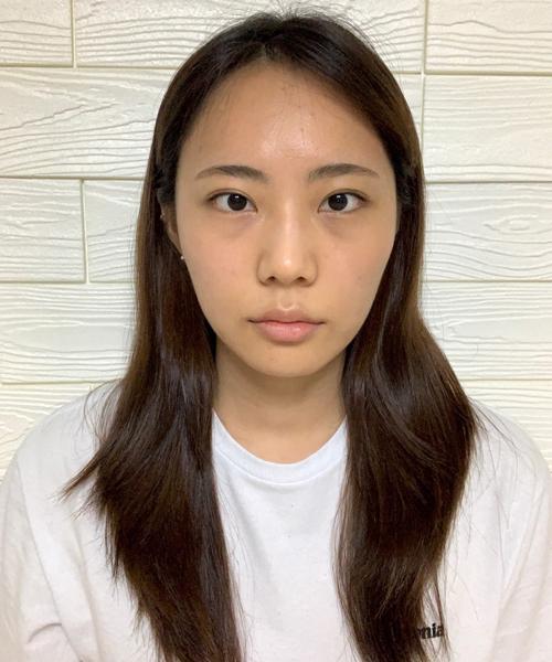 Ulthera & Titanium Lifting & Skin Botox — before (Botox, Filler)