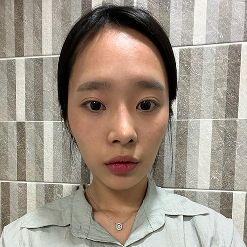 Ulthera & Titanium Lifting & Skin Botox — before (Botox)